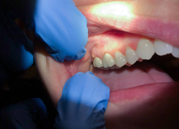 Best Emergency Dental Care for Broken or Chipped Teeth in Bethel Acres, OK